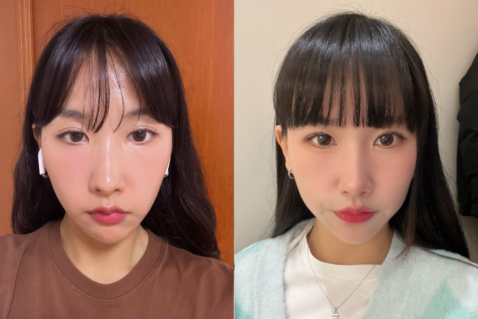 Before and After Plastic Surgery in Korea