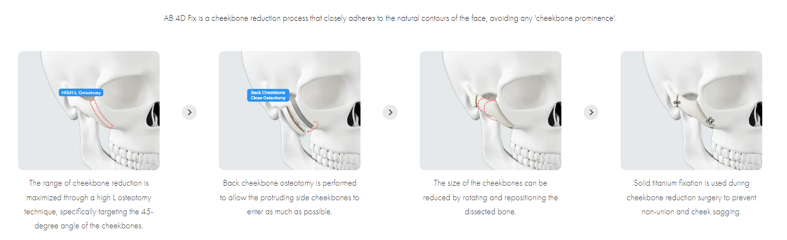 Cheekbone Reduction Plastic Surgery Korea