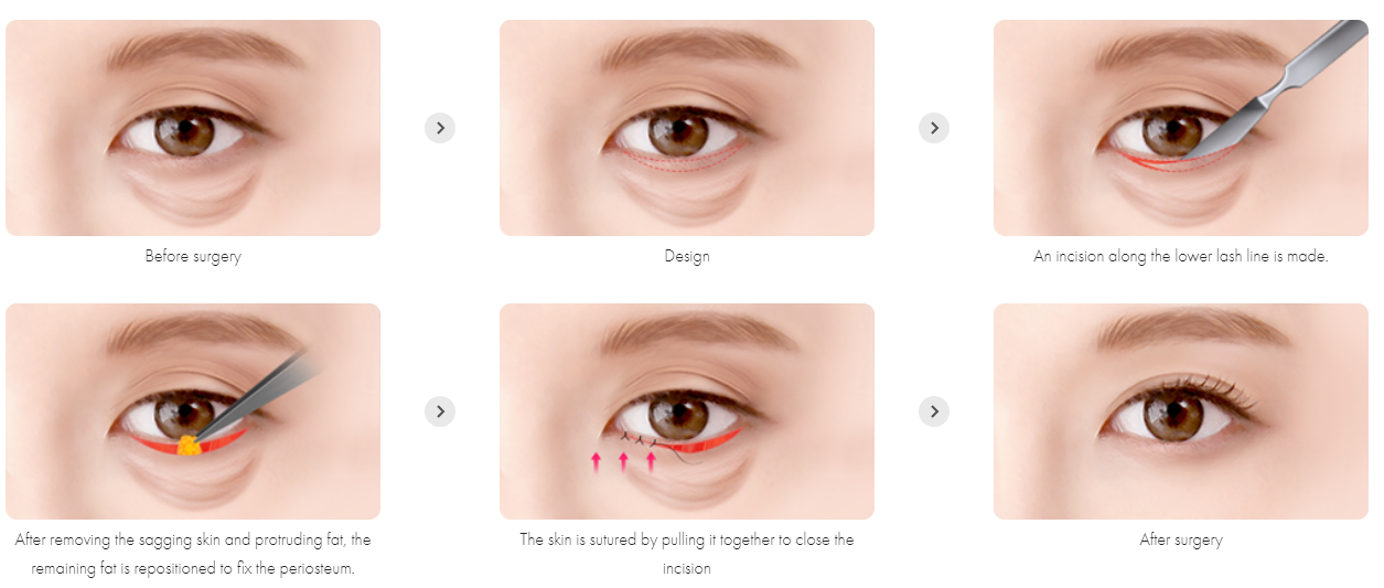 Lower Eyelid Surgery (Lower Blepharoplasty)