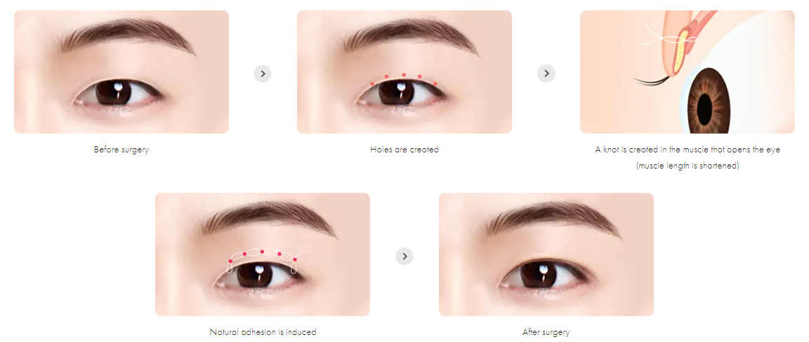 Male Eyeshape Correction in Korea