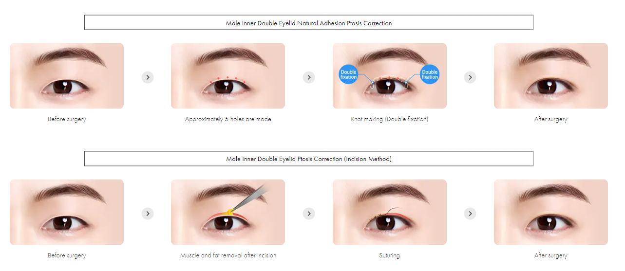 Male Ptosis Correction in Korea