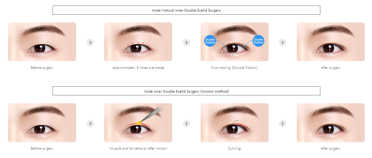 Male Double Eyelid Surgery Korea