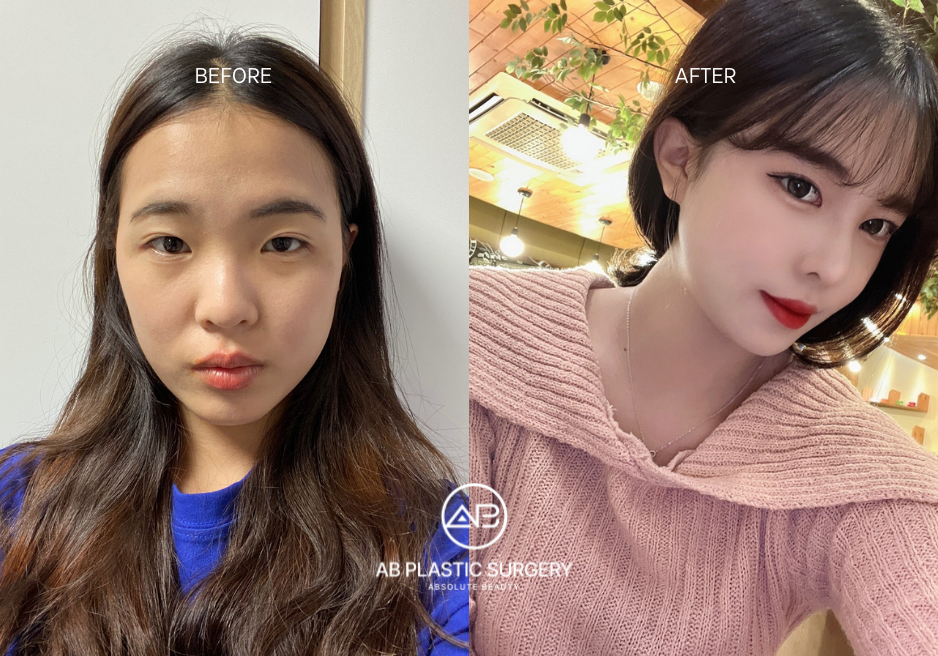 Results of the Plastic Eye and Nose Surgery in Korea
