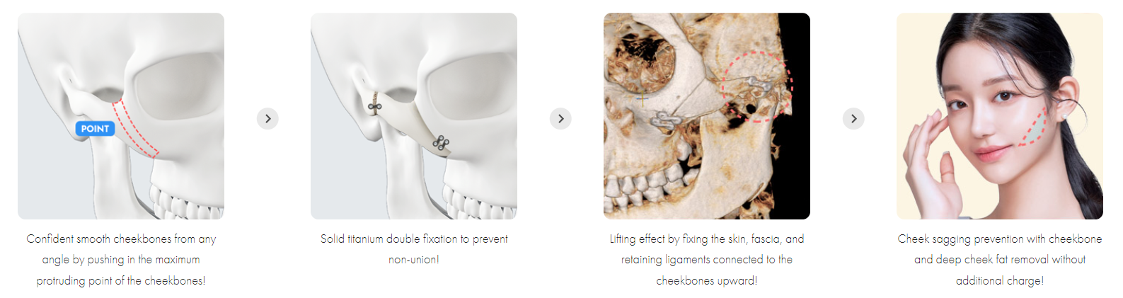 One of Facial Contouring Techniques: Cheekbone Reduction