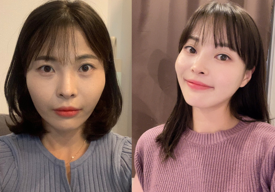 Effect of the Anti-Aging Procedures at AB Plastic Surgery