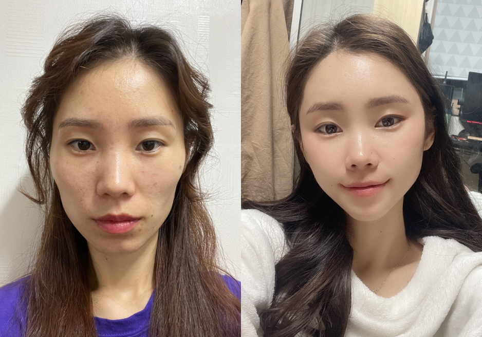 Anti-Aging Procedures in Korea