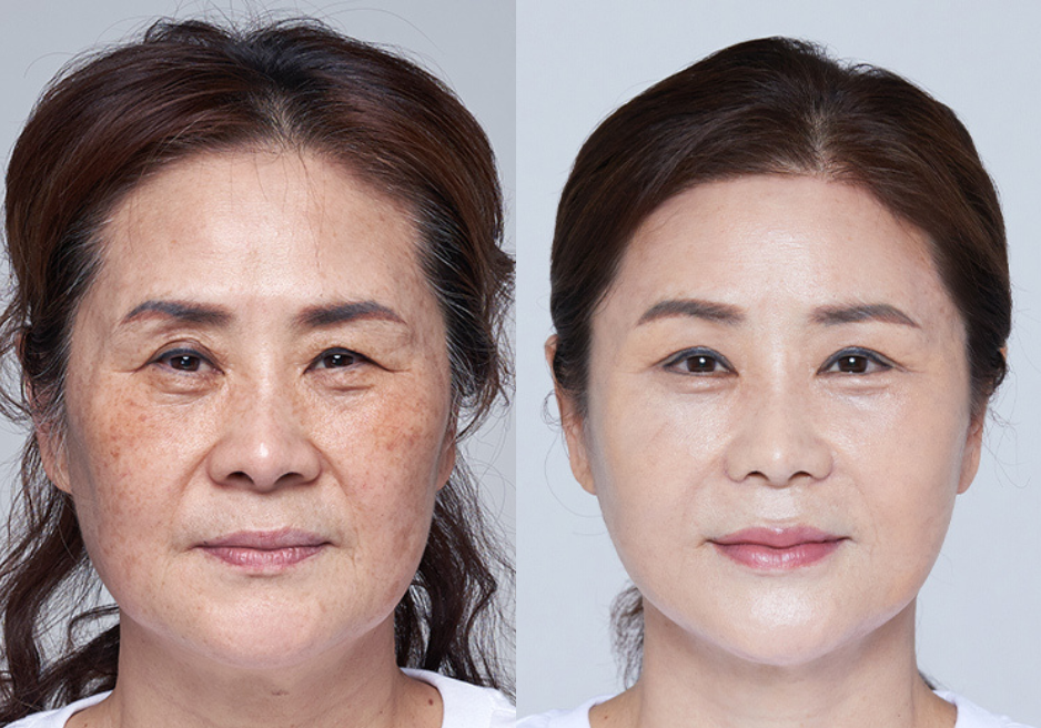 Most Popular Anti-Aging Procedures in Korea
