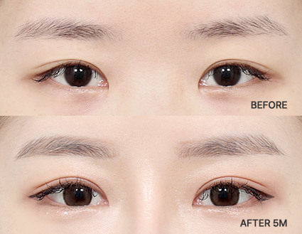 Revisional Eye Surgery in Korea