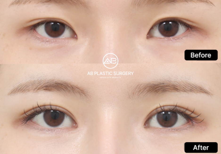 almond-eye-surgery-canthoplasty-before-after