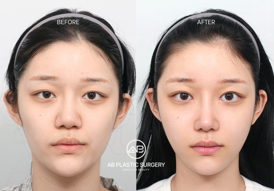 Korean-Facial-Slimming-Techniques-for-Wide-Face