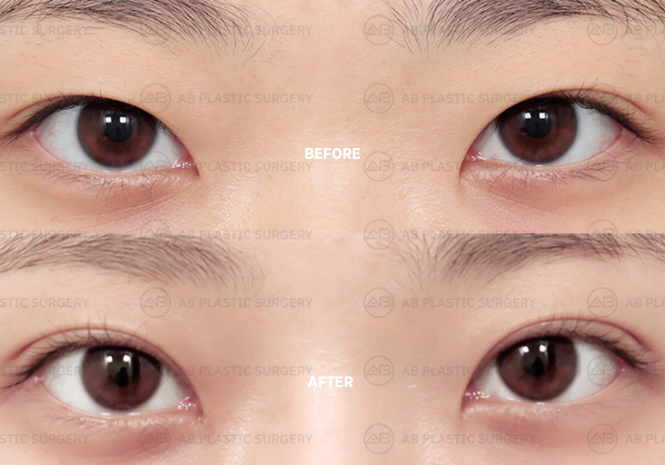 double-eyelid-surgery-in-korea-before-after