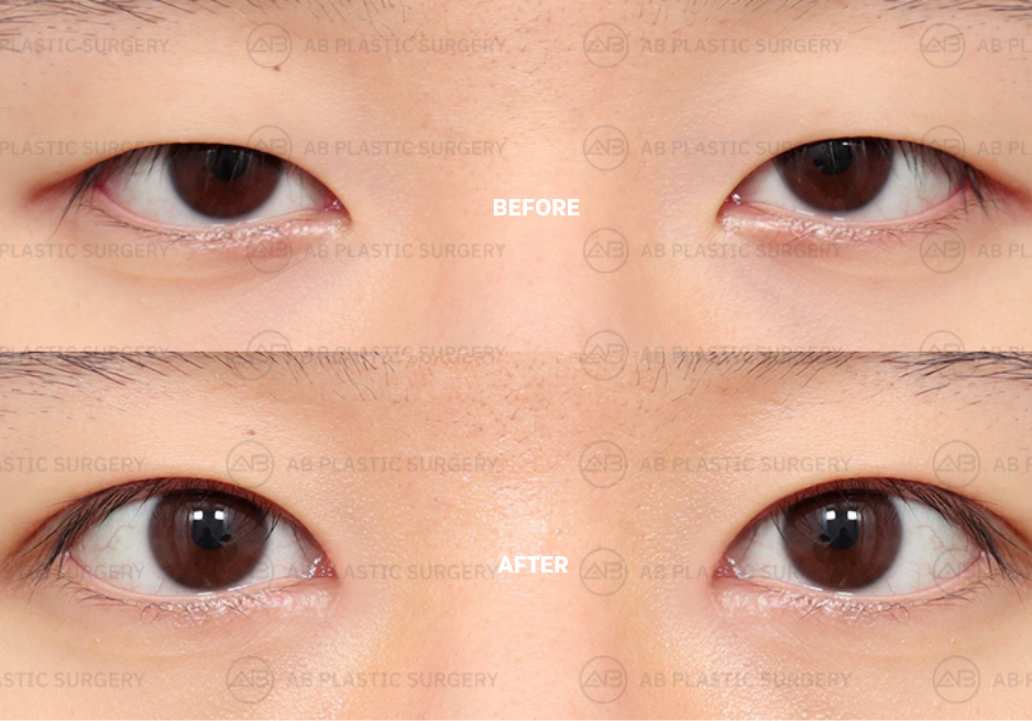 reasons-to-do-double-euelid-surgery-in-korea
