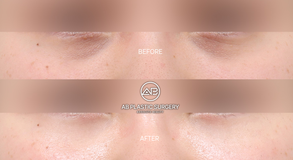 eyes-rejuvenation-with-thermage-flx-in-korea