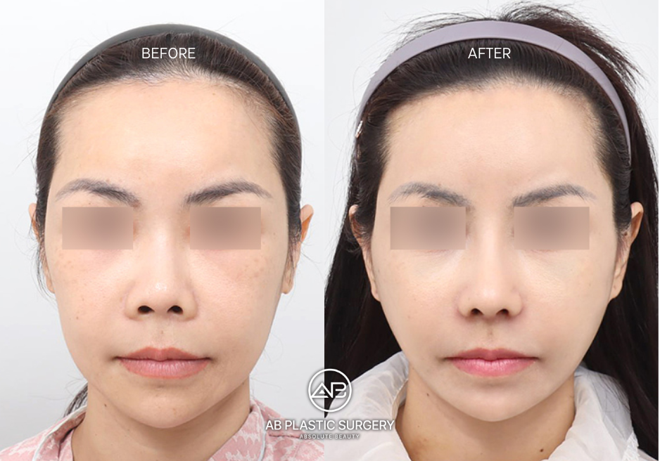 thermage-flx-for-face-skin-rejuvenation-in-korea-price