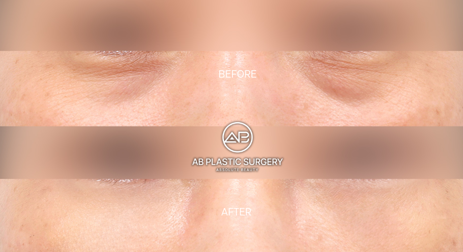 thermage-flx-in-korea-for-eyes