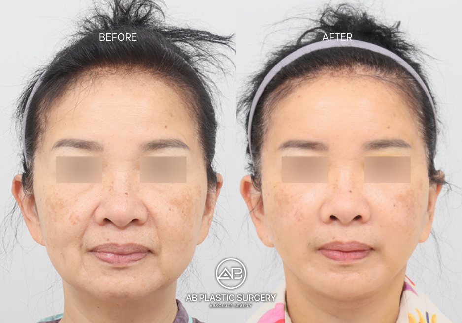 thermage-flx-in-korea-for-face-skin-lifting