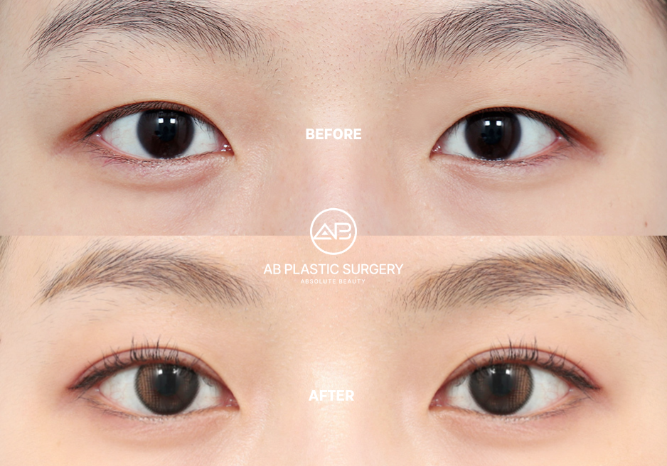 canthoplasty-in-korea-price-and-tips