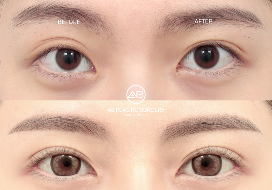 canthoplasty-in-seoul-south-korea-before-after-results