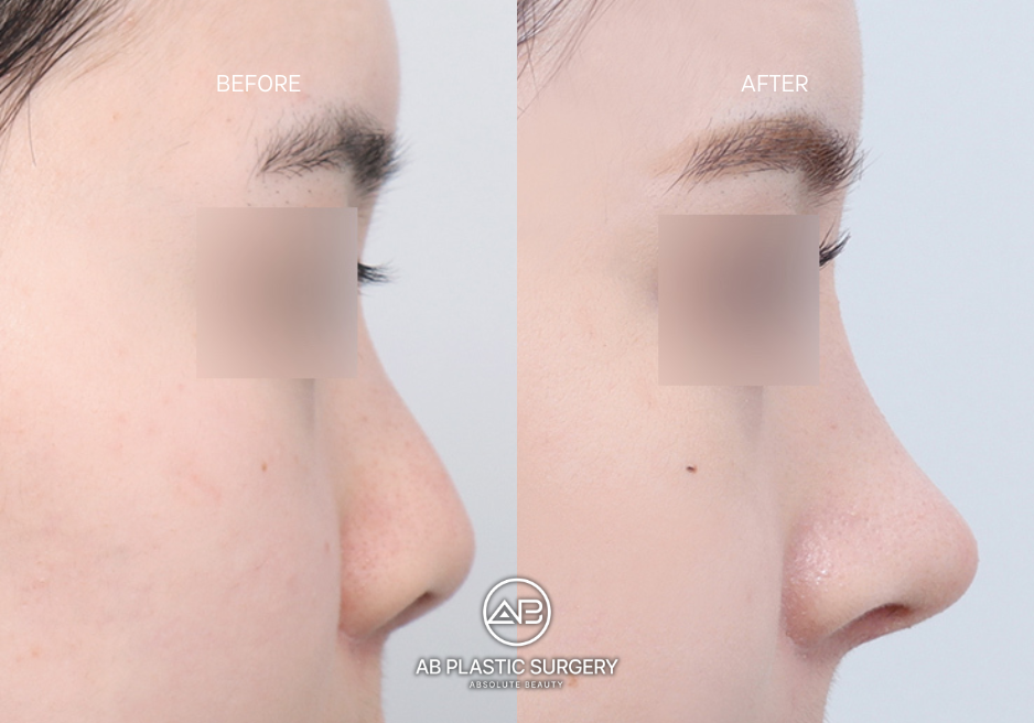 flat-nose-surgery-south-korea