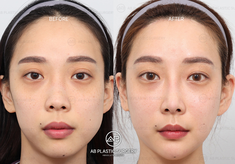 why-cjoose-korea-for-facial-contouring-surgery
