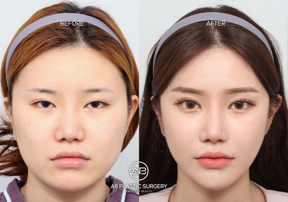 Is-Forehead-Reduction-Surgery-in-Korea-Right-for-You