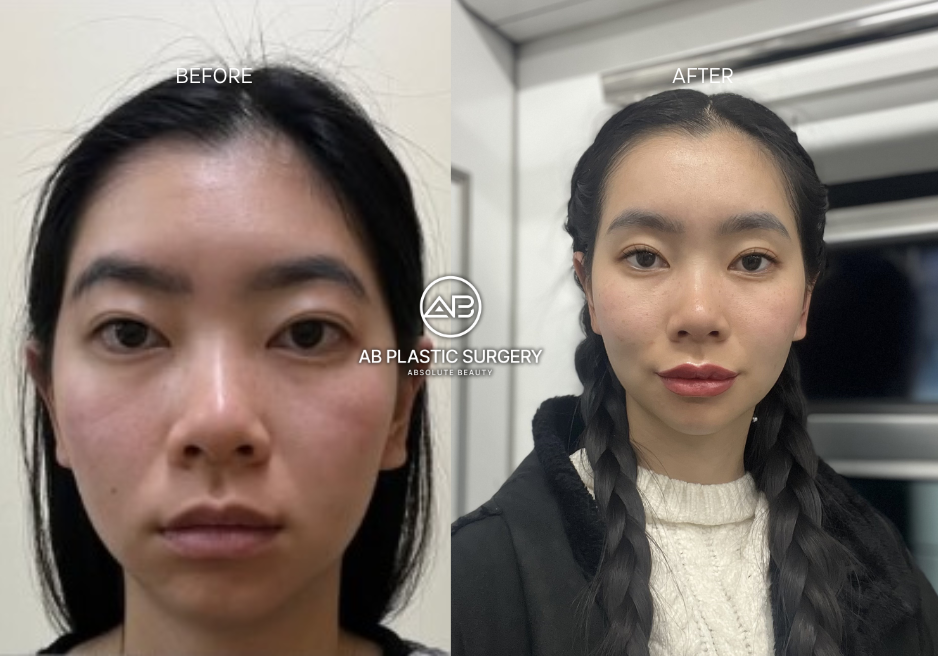 Understanding-he Korean-Beauty-Standard-and-Its-Impact-on-Results-of-plastic-surgery-in-korea