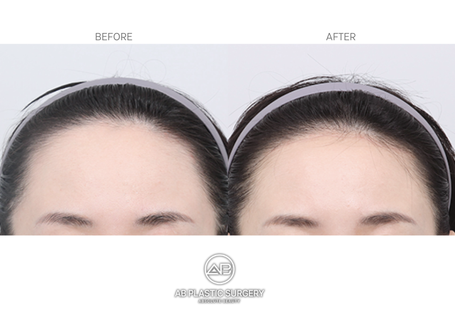 Why-International-Patients-Choose-AB-Plastic-Surgery-for-Forehead-Reduction