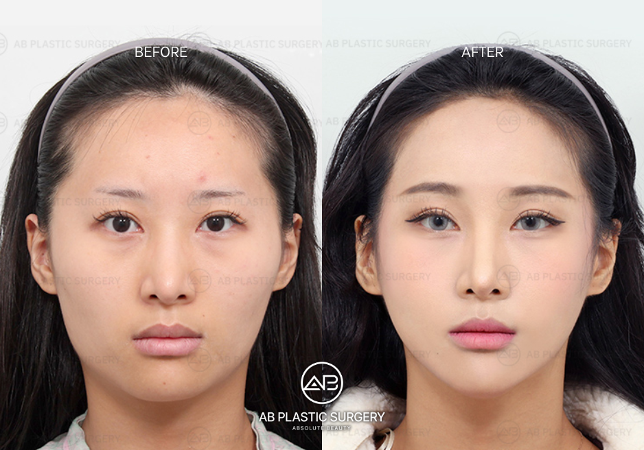 Why-Korea-Leads-the-World-in-Forehead-Reduction-7-Key-Advantages