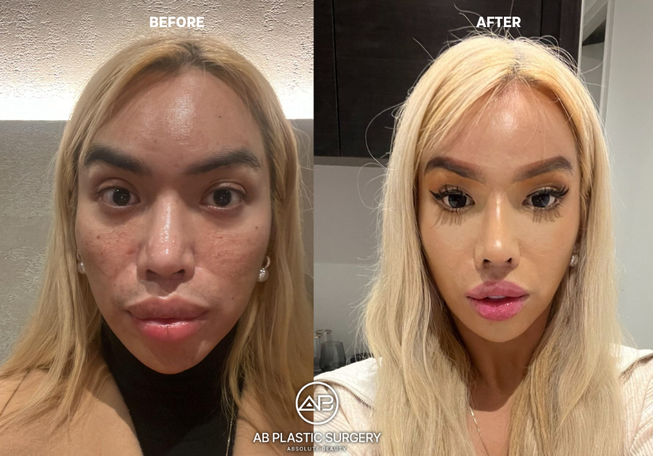 face-feminization-surgery-korea-seoul-before-and-after