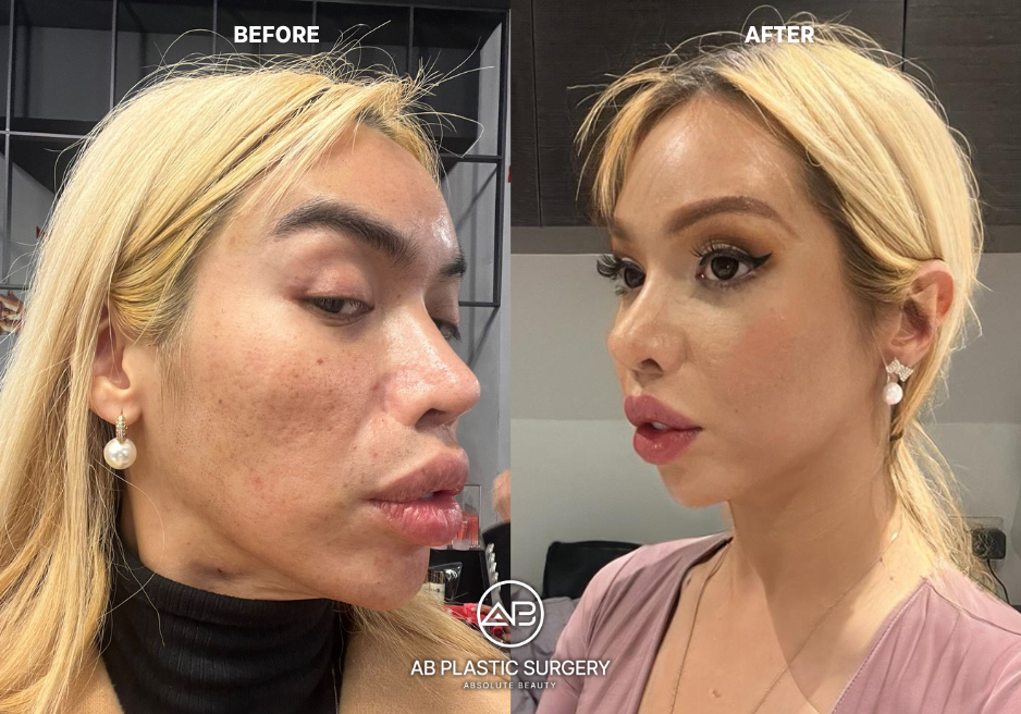 face-feminization-surgery-korea-seoul-results
