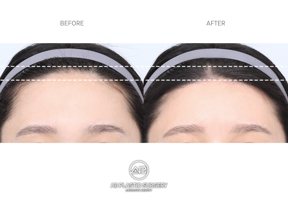 forehead-reduction-surgery-in-korea-before-after