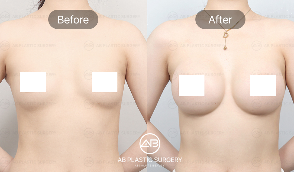 before-and-after-breast-augmentation-in-korea
