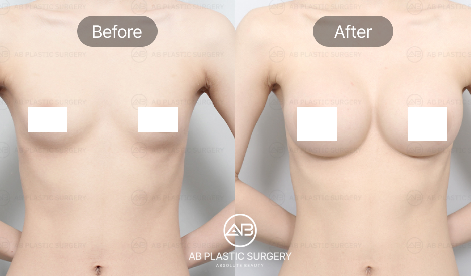 boob-job-in-korea-seoul-before-after