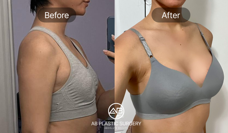 breast-augmentation-in-korea-seoul-before-after
