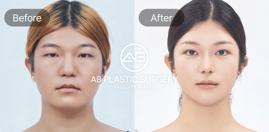 cost-of-the-plastic-surgery-in-south-korea-seoul