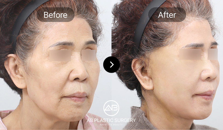 facelift-korea-seoul-gangnam-plastic-surgery-before-after