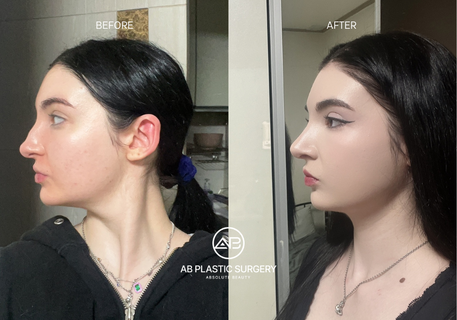 ideal-time-for-plastic-surgery-in-south-korea-seoul-for-foreigners