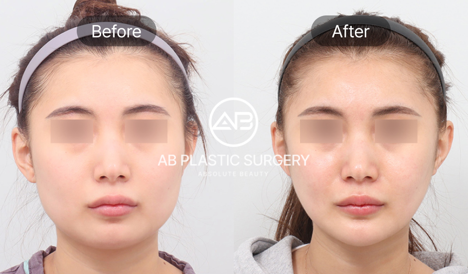 korean-beauty-standards-v-line