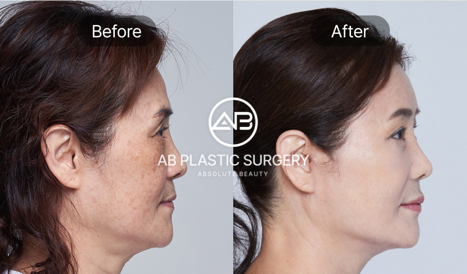 korean-plastic-surgery-approach-to-surgery