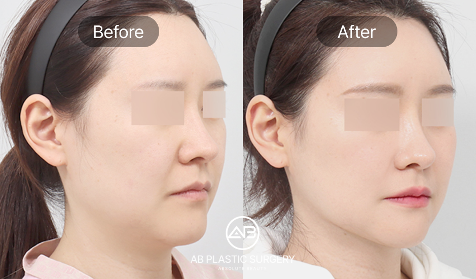 why-choose-seoul-south-korea-for-plastic-surgery