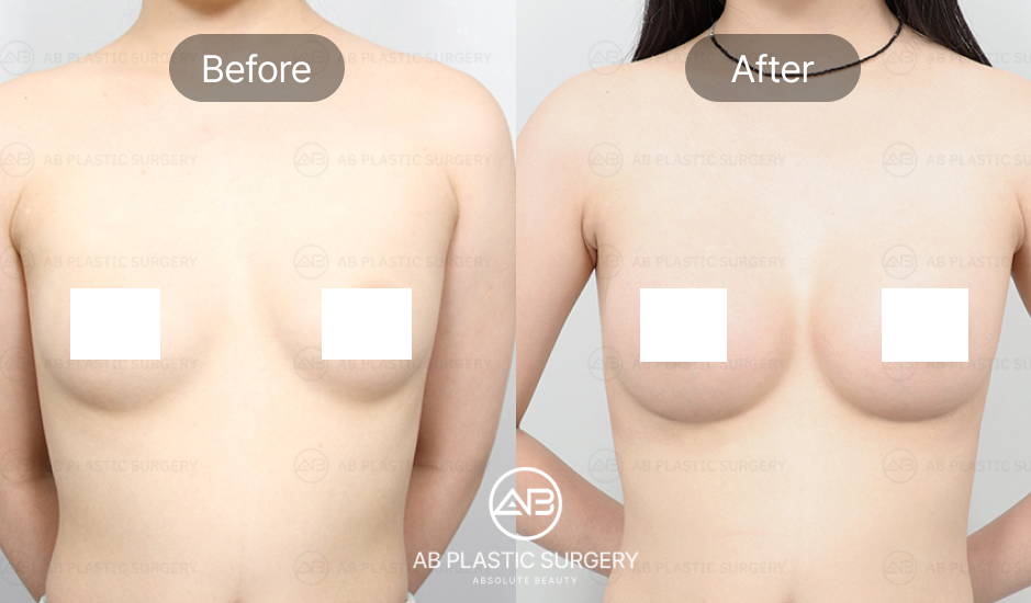 breast-lifting-surgery-in-korea-seoul-for-women-and-men