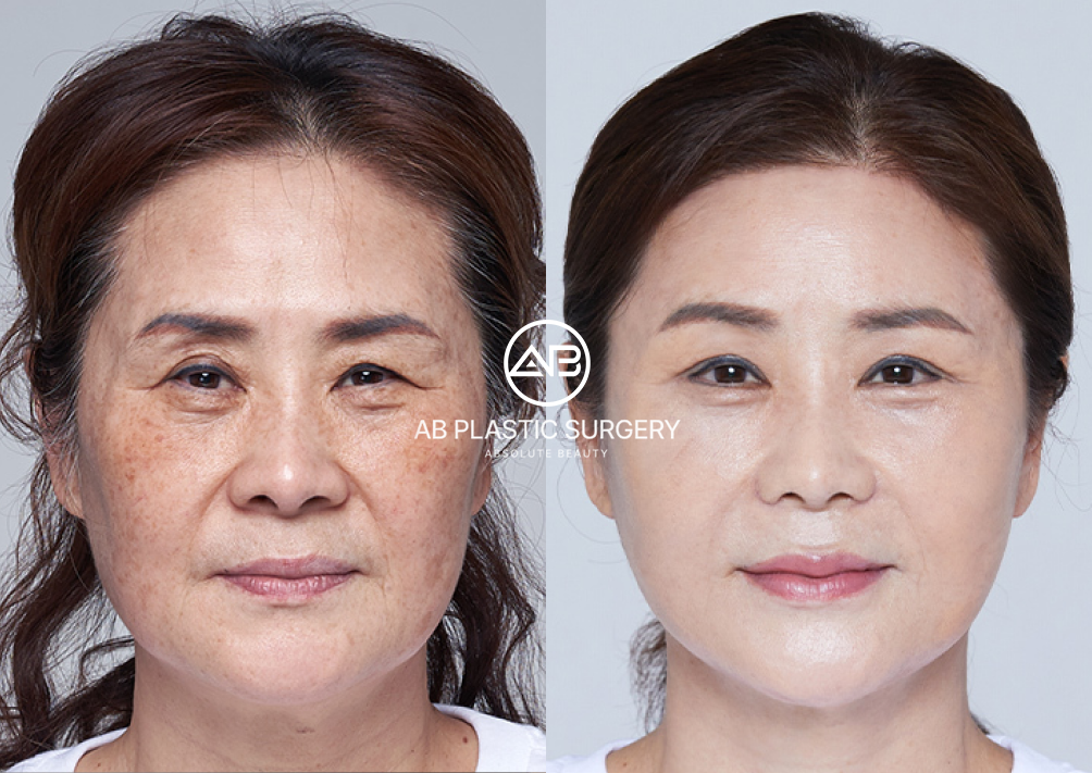 korean-facelift-mini-facelift