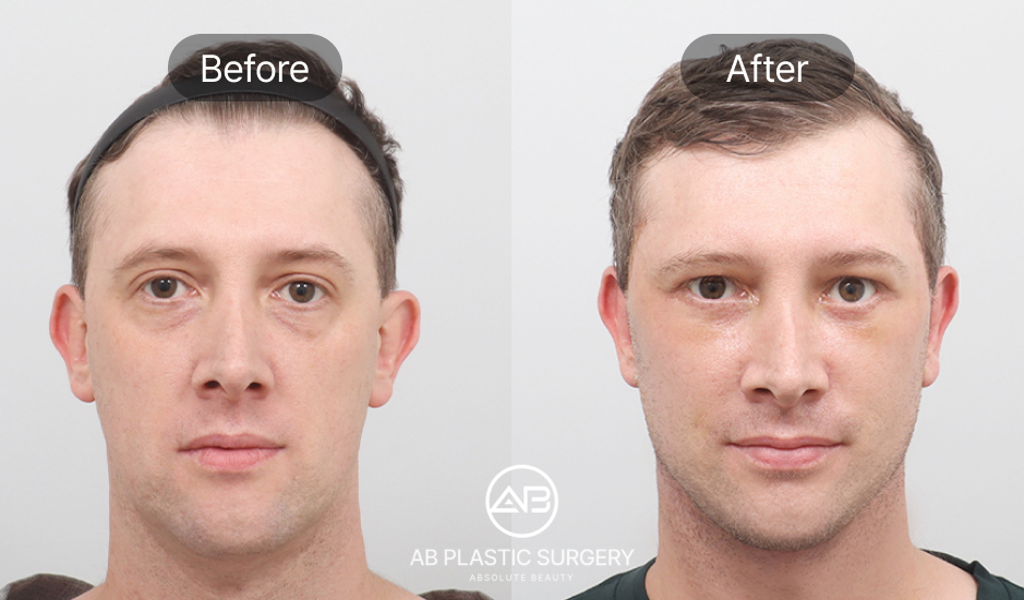 korean-plastic-surgery-for-man-seoul