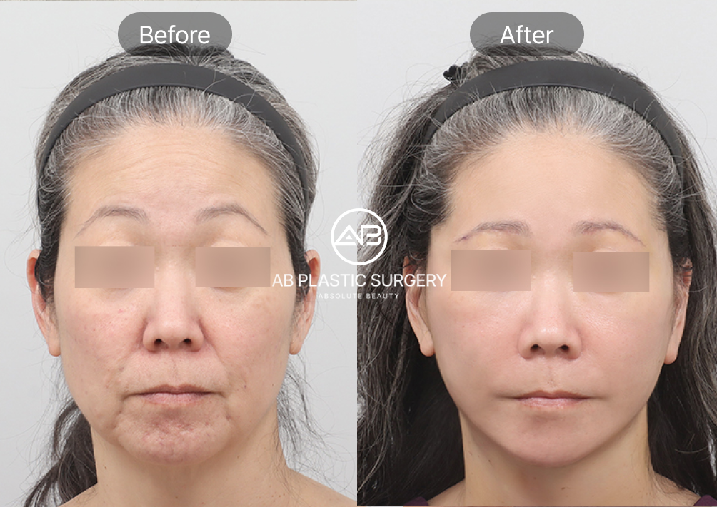minimally-invasive-face-liting-procedure-for-nasolabial-folds-seoul-south-korea