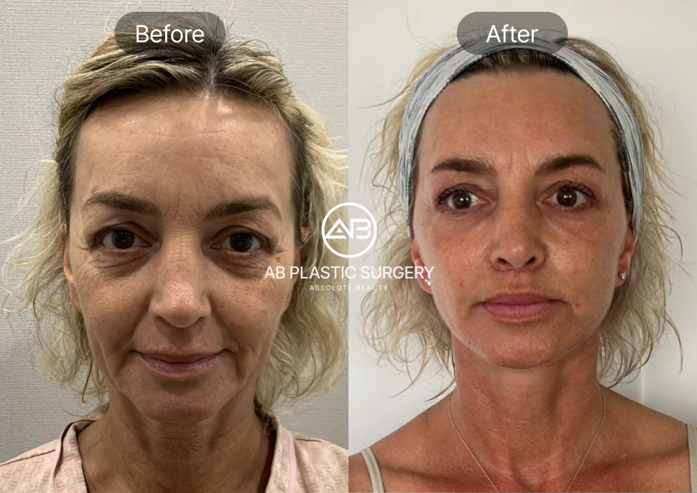 minimally-invasive-procedures-in-south-korea-thread-face-lifting