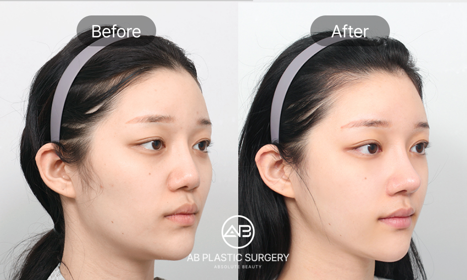 what-makes-korean-plastic-surgery-different