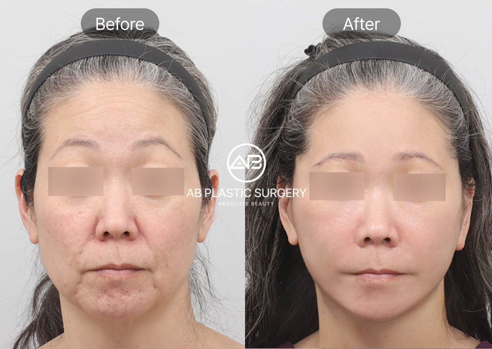 Korean-Anti-Aging-nasolabial-folds-laugh-lines-surgery-before-after