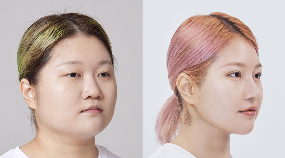 Mandible-Reduction-Surgery-vs-Jaw-Fillers-korea-seoul