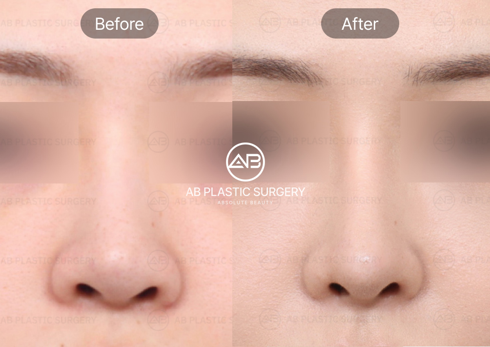 alar-resection-in-seoul-korea-korean-nose-job