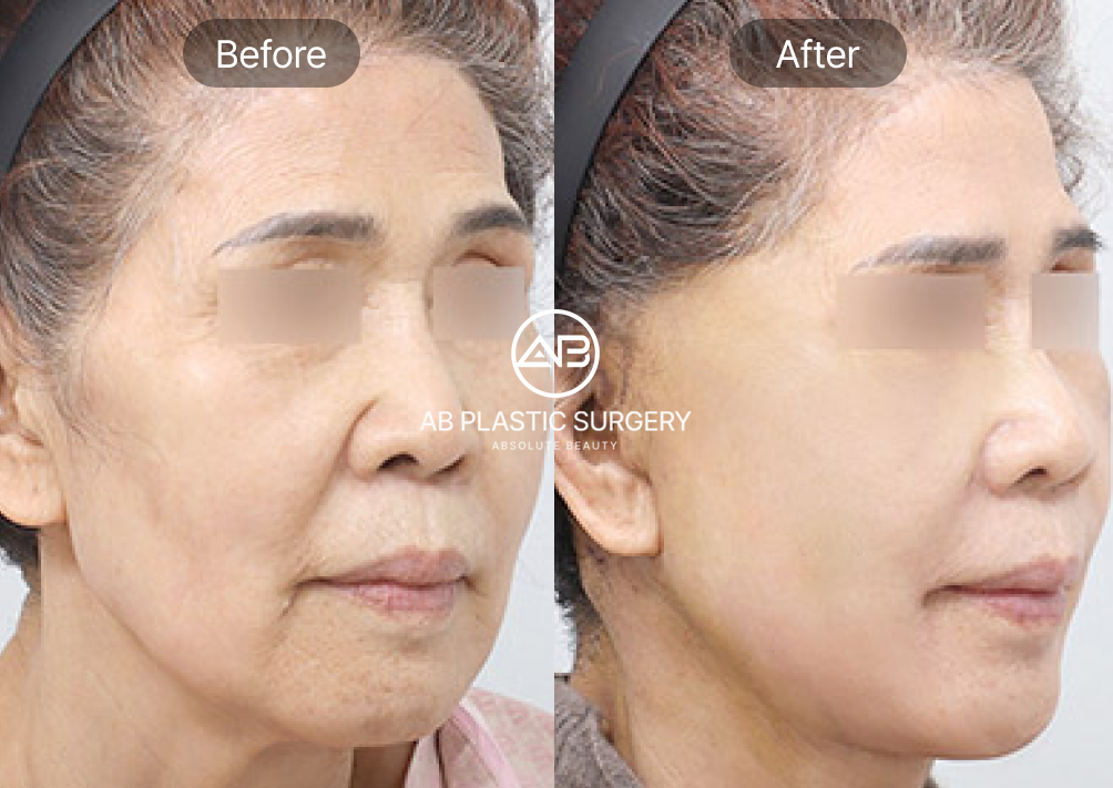 face-lifting-anti-aging-korea-seoul